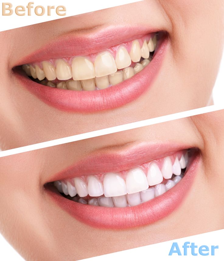 PureSmile Whitening Strips